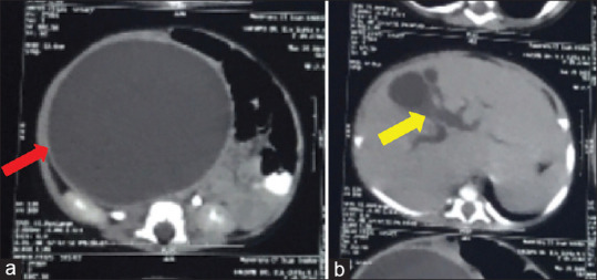 MDCT abdomen showing giant choledochal cyst of size 16 cm × 12 cm × 8 cm (red arrow) (a) and dilated IHBR (yellow arrow) (b). IHBR: Intrahepatic biliary radicals, MDCT: Multidetector computed tomography