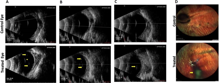B-scan ultrasonography in three representative eyes following treatment with RCBD + CBD: Representative images of eyes treated with CBD and RCBD showing complete PVD (Panels A and B, marked by arrows), and partial PVD (Panel C), along with the corresponding contralateral eyes (controls). (Panel D) Fundus of representative rabbit eye with complete PVD, following the intravitreal injection of combination of CBD and RCBD; the posterior hyaloid membrane appears as a shadow in the fundus image which reflects PVD (marked with arrow).