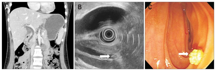 Common bile duct stone findings on endoscopic ultrasonography (EUS) and endoscopic retrograde cholangiopancreatography (ERCP) in patients with negative computed tomography findings. (A) No choledocholithiasis is apparent on computed tomography in the coronal view. (B) A 4-mm ovoid hyperechoic lesion with posterior acoustic shadowing (white arrow) identified in the distal common bile duct during EUS. (C) A 4-mm cholesterol stone (white arrow) removed by ERCP.