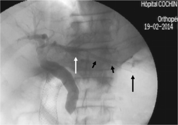 Cholangiographic view after transhepatogastric stent release in a patient with previously stented duodenal obstruction and distal biliary stricture. With arrow: intraductal stent end; long black arrow: intragastric stent end; short black arrows: stent portion traversing the liver parenchyma.