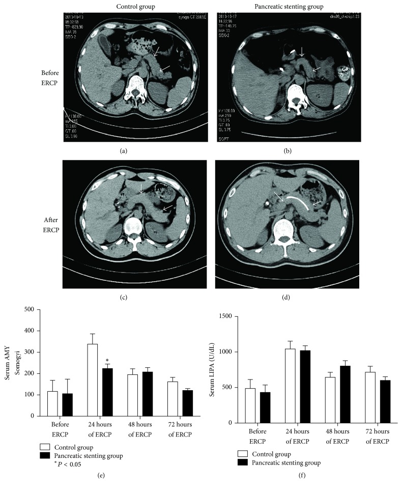 Occurrence and resolution of PEP: (a–d) representative computed tomography scan of the experimental (with pancreatic duct stenting) and control groups (without stenting) before and after ERCP showing obvious PEP (as indicated by the white arrow) in the control group; serum levels of (e) amylase and (f) lipase before ERCP and 24 h, 48 h, and 72 h after ERCP.