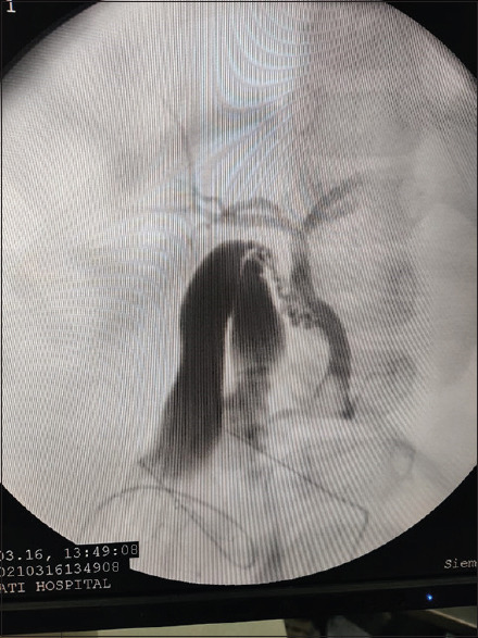 Intraoperative cholangiogram showing double gall bladder draining into the common hepatic duct by single cystic duct