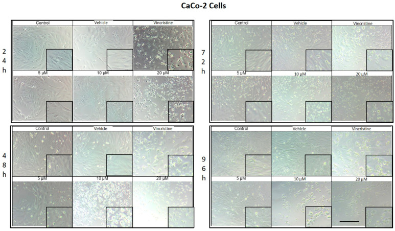 CaCo-2 cells treated with CBD and controls for 24, 48, 72, and 96 h. Treatments included CBD at concentrations of 5, 10, and 20 μM, 1 μM vincristine, methanol (vehicle), and culture medium (control). Scale bar: 300 μm.