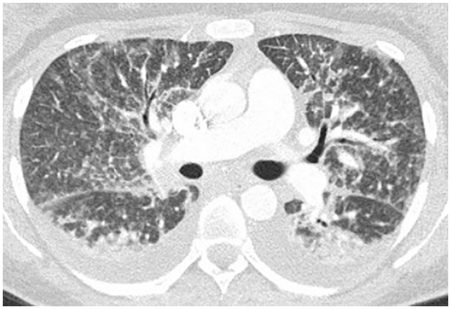 Bilateral pleural effusions with peribronchovascular ground glass infiltrates with septal thickening, nodular pattern.