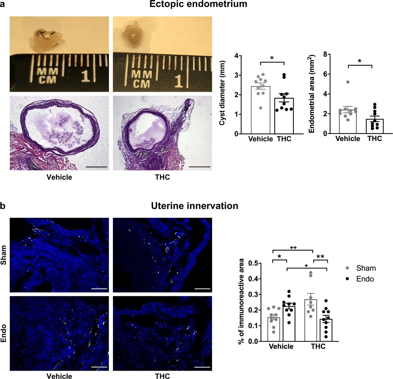 Effects of THC on the histological changes observed in mice with ectopic endometrium.(a) Ectopic endometrial growths of mice treated with THC were smaller and had less endometrial tissue than those of mice receiving vehicle. Scale bar = 1 mm. (b) THC increased innervation in sham mice but prevented uterine hyperinnervation in endometriosis mice. Blue is DAPI and white is β-III tubulin. Scale bar = 100 μm. Error bars are mean ± SEM. Student t-test (a) and two-way ANOVA + Bonferroni (b). *p<0.05, **p<0.01 vs sham. +p<0.05, ++p<0.01 vs vehicle. Endo, endometriosis; THC, Δ9-tetrahydrocannabinol; a.u., arbitrary units. Figure 4 - Figure supplement 1. Figure 4 - Source data.