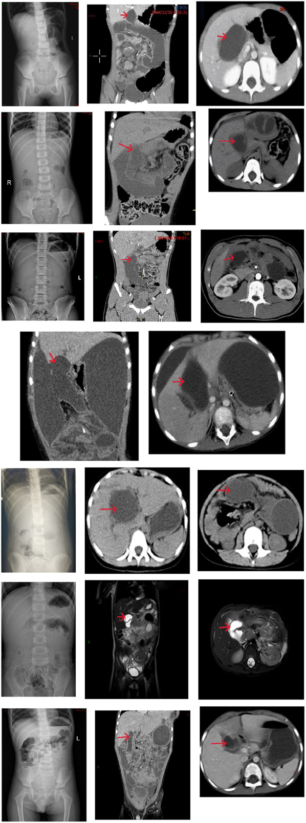 Case 1: The bile duct Y-loop is twisted 720°, appearing as a cord-like structure. The arrow indicates the dilated bile duct loop at the first hepatic hilum. Case 3: Transverse mesocolic defect hernia (small intestine herniates through the mesocolic defect, with the herniated segment located 130 cm from the cecum). The arrow indicates the dilated bile duct loop at the first hepatic hilum. Case 5: Petersen's hernia (proximal jejunum, including the jejunojejunal anastomosis, herniates into the Petersen's space causing a 720° rotation of the bile duct loop and necrosis of the bile duct loop). The arrow indicates the dilated bile duct loop at the first hepatic hilum. Case 6: Brolin hernia (the bile duct loop herniates into the Brolin's space, with complete necrosis of the biliary-jejunal loop and the biliary-jejunal loop jejunojejunal anastomosis). The patient did not undergo an abdominal x-ray preoperatively. The arrow indicates the dilated bile duct loop at the first hepatic hilum. Case 7: Transverse colonic mesenteric defect hernia (the proximal jejunum, including the jejunojejunal anastomosis, herniates into the colonic mesenteric defect, resulting in necrosis of the bile duct loop). This patient underwent intestinal obstruction surgery at a medical alliance hospital and no coronal CT images were available. The arrow indicates the dilated bile duct loop at the first hepatic hilum. Case 8: Petersen's hernia (herniation of the intestinal segment, 120 cm from the cecum, into the Petersen's space). The patient did not undergo abdominal CT examination. The arrow indicates the dilated bile duct loop at the first hepatic hilum. Case 9: Colonic mesenteric defect hernia (herniation of the intestinal segment, 100 cm from the cecum, into the mesocolic defect of the transverse colon). The arrow indicates the dilated bile duct loop at the first hepatic hilum.