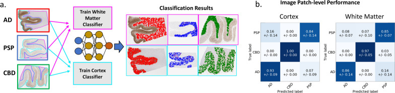 Disease classification from DL. a Overview of our DL approach in which cortex/WM regions are used to train two separate DL models for disease classification at an image patch level. b Confusion matrices comparing the average patch-level classification accuracy using cortex (left) or WM (right) data