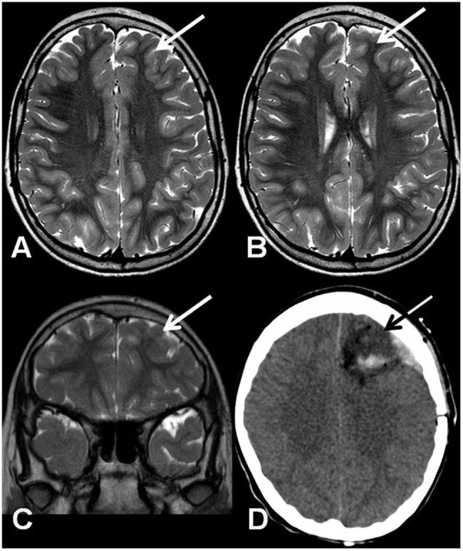 (A,B) Axial T2-weighted TSE MRI. Coronal T2-weighted TSE MRI (C) and axial computed tomography after surgery (D). The arrows show a mildly hypoplastic frontal lobe with focal T2 signal hyperintensity on the cortico-subcortical transition (A–C) and the resected region (D).