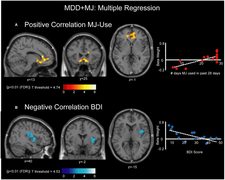 Correlations between MJ use, BDI score, and activation. (A) Left panel shows voxels with significant positive correlation with MJ use, overlaid on a normalized T1-weighted anatomical image at MNI planes of view indicated to clarify localization. P = posterior, A = anterior, L = left, R = right. (A) Right panel shows a scatter plot indicating the relationship between individual participant beta weights of the identified voxels and the number of times they used MJ in the past 28 days. Line of best fit plotted in white. (B) Left panel shows voxels with significant negative correlation with BDI, overlaid on a normalized T1-weighted anatomical image at MNI planes of view indicated to clarify localization. P = posterior, A = anterior, L = left, R = right. (B) Right panel shows a scatter plot indicating the relationship between individual participant beta weights of the identified voxels and BDI score. Line of best fit plotted in white.