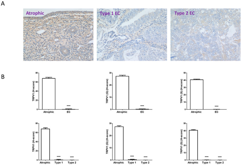 TRPV1 immunohistochemistry staining patterns. Panel (A) shows brown (DAB) staining for TRPV1 in representative sections of control (Atrophic), Type 1 and Type 2 endometrial cancer (EC) tissues. Images were captured at 200× magnification. Staining of both stromal and glandular and luminal epithelial tissue is noted in the control tissue, with slightly higher intensity staining within the stromal compartment. By contrast, overall staining levels in the EC tissues were reduced when compared to the control tissue. Panel (B) shows the histomorphometric analyses for the whole tissue, for the glands (G) alone or the stroma (S) alone. The histoscore (H-score) was significantly reduced in the entire tissue, glands and stroma (top set of graphs) when compared to the atrophic control (**** p < 0.0001; Student’s t-test). Sub-type analysis of the Type 1 and Type 2 EC samples indicated that overall staining H-score levels in both types of EC tissues were reduced when compared to the control tissue (lower set of graphs), regardless of whether the entire tissue, glands and stroma when compared to the atrophic control (**** p < 0.0001; one-way ANOVA with Tukey’s HSD test).
