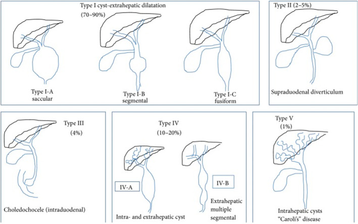 Todani's classification of choledochal cysts.