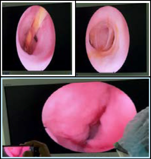 Choledochoscopy (A) stent visualisation (B) proximal hepatic ducts (C) opening into duodenum