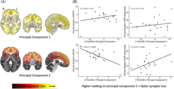 (A) Brain maps illustrating principal components 1 and 2 weighting (yellow = faster synaptic loss) obtained from a principal‐component analysis of the annualized proportional change in [11C]UCB‐J BPND. (B) Scatterplots showing the relationship between symptom severity (progressive supranuclear palsy [PSP] Rating Scale)/Addenbrooke's Cognitive Examination–Revised (ACE‐R) and individual participant loadings on principal components 1 (top row) and 2 (bottom row). [Color figure can be viewed at wileyonlinelibrary.com]