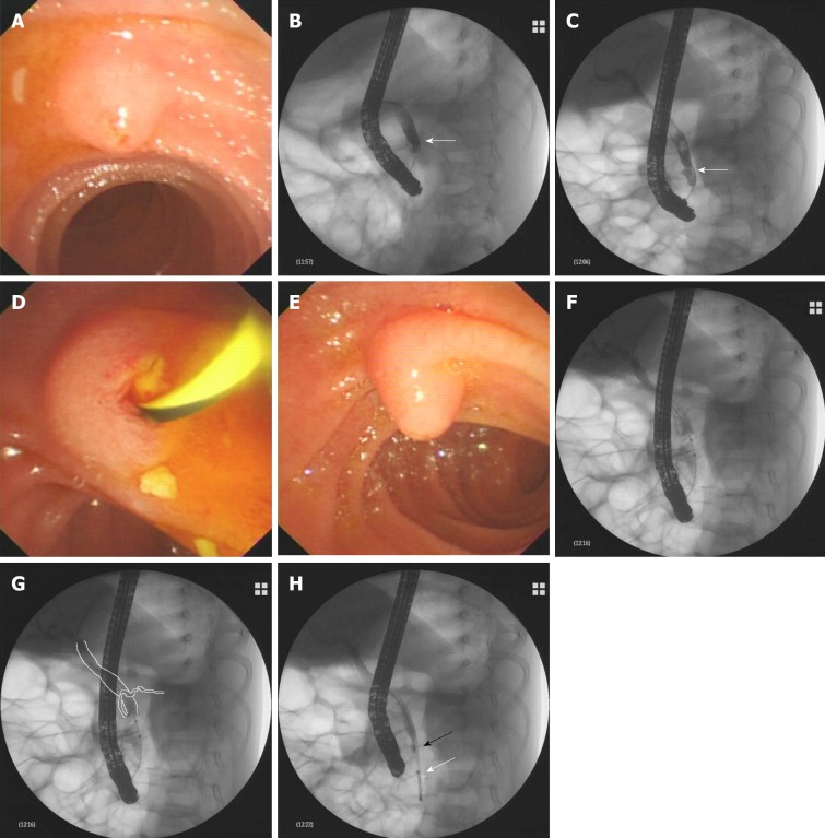 Results of endoscopic retrograde cholangiopancreatography. A: During endoscopic retrograde cholangiopancreatography, a hemispheric papilla with a villus-like opening resembling the major papilla was seen. B-E: Successful cannulation of the papilla and a dilated common bile duct (CBD) detected by X-ray after injection of a contrast agent (B). Multiple small biliary stones were discharged from the papilla after minor endoscopic sphincterotomy (D). Beneath the papilla, the real major papilla was detected (E). After cannulation of the major papilla, the CBD was observed again, which was dilated with multiple filling defects (C), and at the level of the middle–lower CBD, narrowing was observed (arrow); F: During removal of the biliary stones with an endoscopic balloon, unexpectedly, the dorsal pancreatic duct was revealed at the level of the middle–lower part of the CBD; G: Schematic representation of the image of F; H: After clearance of the CBD with the balloon, an 8.5 Fr 4-cm pigtail plastic pancreatic stent was placed in the biliary duct through the major papilla (white arrow); the minor papilla was cannulated again; and the guidewire was advanced into the CBD (black arrow).