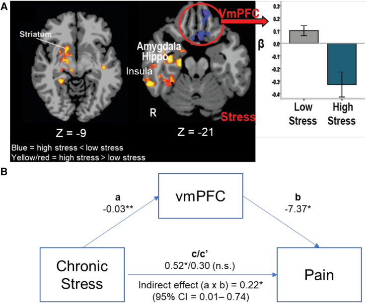 VmPFC, stress, and pain. (A) High Stress group (N = 25) show greater limbic-striatal (amygdala, hippocampus, insula and striatum) responses during acute stress exposure compared to the Low Stress (N = 25), but lower, more hypoactive VmPFC response to stress in the high vs. low stress groups (105). (B) The ROI of the hypoactive VmPFC response was entered in a mediation analysis to assess whether VmPFC functional response during acute stress mediated the effects of chronic stress on greater self reported pain symptoms (N = 50). Mediational analysis indicated that high chronic stress was associated with lower stress-induced VmPFC response (a process: −0.03, p < .01) and lower the VmPFC response, higher the reported pain symptoms (b process: −7.37, p < .05), and that the direct significant effect of high chronic stress associated with high pain symptoms (c = 0.52, p < .05) was fully accounted by the stress-induced VmPFC functional response (indirect effect c′: a × b = .22, p < .05, 95% CI = .01–.74), such that the direct effect of chronic stress on pain symptoms was no longer significant once the stress-related VmPFC response was included in the mediational mode (Direct effect c/c′ = 0.52/0.30, p = ns). *p < .05, **p < .01.