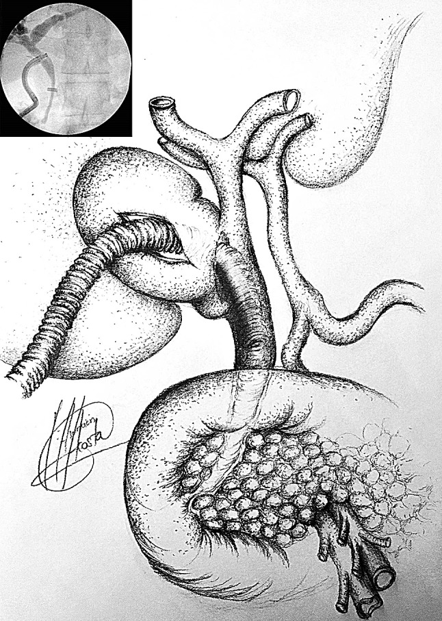 IOC case 11, access from infundibulum to CBD with choledochoscope through cholecystobiliary fistula