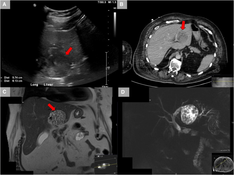 Radiological studies. (A) Ultrasound showing the left hepatic lobe heterogeneous area. (B) CT scan with contrast showing a lesion in the left lobe of the liver demonstrates areas of internal enhancement and a mildly distended gall bladder. (C) MRCP showing a lesion in the left hepatic lobe measuring up to 5 cm. (D) MRCP showing mild gall bladder wall edema without additional signs of cholecystitis and mild CBD dilatation of 9 mm without evidence of choledocholithiasis. CT, computed tomography; MRCP, magnetic resonance cholangiopancreatography; CBD, common bile duct.