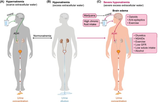 Water balance homeostasis and Bruce Lee's risk factors for hyponatraemia. Hypernatraemia means that there is a deficiency in extracellular water and the body adapts by increasing water intake through thirst and decreasing water loss in urine by secreting antidiuretic hormone (ADH), which results in more a concentrated, lower amount of urine (A). If hyponatraemia develops, these mechanisms will be shut down, resulting in an increased volume of more dilute urine (B). Severe hyponatraemia may result from failure to timely shut down mechanisms that increase water intake and decrease water excretion once hyponatraemia has developed (C). Severe hyponatraemia may trigger cerebral oedema and herniation through the foramen magnum in the occipital bone of the skull, resulting in death within hours. Green arrows indicate adaptive mechanisms. Red arrows indicate mechanisms that are inappropriately activated and not in line with physiological needs to maintain water homeostasis. Lee had several risk factors for severe hyponatraemia that interfered with all levels of control of water balance, from thirst to ADH secretion to ADH action in the kidneys to decrease water excretion in urine.