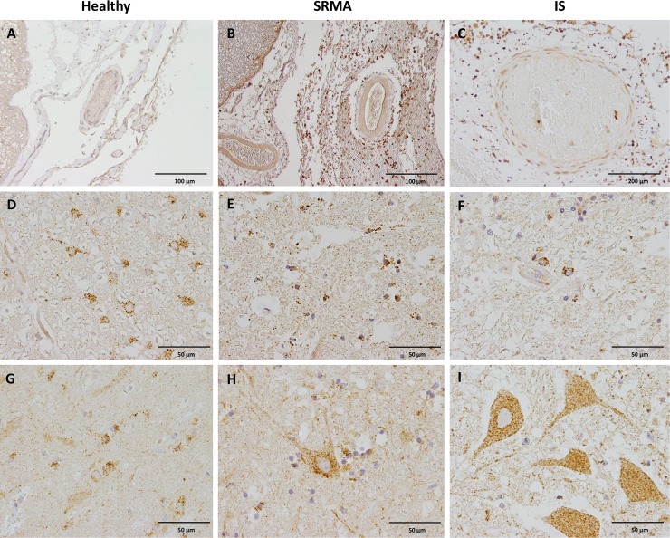 CB2 immunoreaction in spinal cord sections of dogs with SRMA, IS and healthy controls.A) Detail of blood vessel and meninges of a healthy dog, notice lack of immunoreaction in the adventitia, endothelial cells, flat mesothelial-like arachnoid membrane cells and pia matter cells. B) Blood vessel of a dog with SRMA characterized by strong perivascular and subarachnoidal CB2 positive inflammatory infiltrates and slight to moderate CB2 immunoreaction within the smooth muscle cells of the tunica media. C) Blood vessel of a dog with IS, slight CB2 immunoreactivity is seen in the tunica media of the vessel whereas perivascular inflammatory infiltrates show strong immunoreaction. D) Detail of glial cells in the white mater of a healthy dog with moderate to strong intracytoplasmic CB2 immunoreaction. E) Strong CB2 immunostaining is shown in round glial cells within the white matter of a dog with SRMA. F) Strong CB2 immunoreaction in astrocytes within the white matter of a dog with IS. G) Moderate to strong immunolabeling of astrocytes and slight immunolabeling of neurons with CB2 antibody within the grey matter of a healthy dog. H) Moderate CB2 immunostaining is shown in the cytoplasm of a neuron and adjacent glial cells within the grey matter of a dog with SRMA. I) Strong spotted CB2 immunoreaction in the cytoplasm of neurons within the grey matter of a dog with IS. IHC was performed using the avidin-biotin-peroxidase complex (ABC) method.