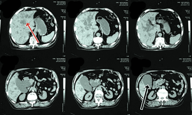 CT of the abdomen and pelvis without contrast showing moderate dilation of the CBD lumen proximal to IHBCs and significant distension of the GB lumenThe red arrow shows the IHBC dilatation. The black arrow shows the distended GB.CT, computed tomography; CBD, common bile duct; IHBC, intrahepatic biliary channel; GB, gallbladder