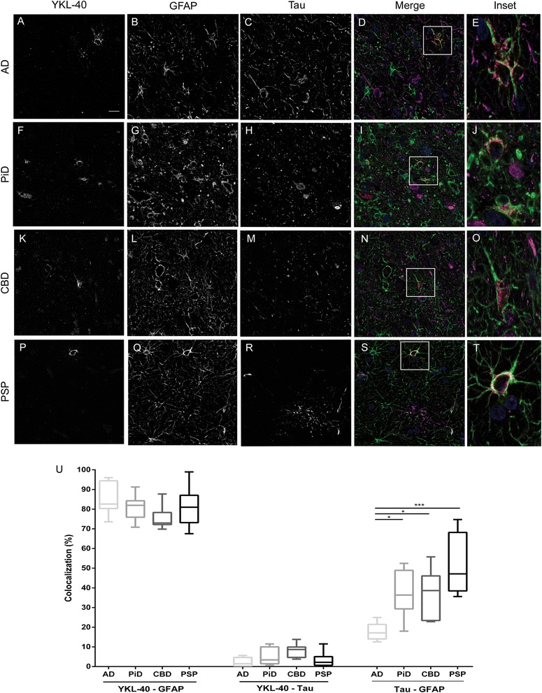 YKL-40 immunoreactivity pattern and colocalization analyses in different tauopathies. Representative images of the triple immunofluorescence studies performed with YKL-40 (red), GFAP (green) and tau (magenta) antibodies. Nuclei are marked in blue. All four tauopathies investigated, a–e AD, f–j PiD, k–o CBD and p–t PSP, showed a cytoplasmic astroglial expression pattern of YKL-40. Scale bar = 20 μm. u Colocalization analysis confirmed that approximately 80% of YKL-40 colocalized with GFAP in all tauopathies. No colocalization was detected between YKL-40 and tau in any condition. As expected, non-AD tauopathies showed an overlap between tau and GFAP. ***p < 0.001; *p < 0.05