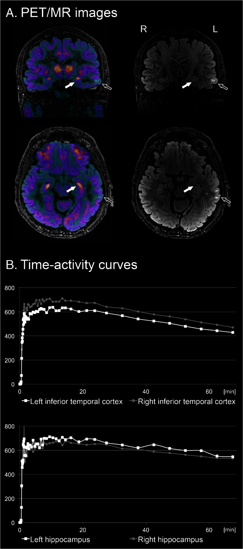 [18F]GE-179 PET/MR scan in a 57-year old temporal lobe epilepsy patient with signal abnormality in left inferior temporal cortex. a PET/MR fusion image (left) and MR FLAIR sequence (right) displaying parts of the lesion (empty arrow) and the hippocampus (full arrow). b Bilateral comparison of time-activity curves (TACs) in the inferior temporal cortex (above) and the hippocampus (below). Both visual analysis and TACs show reduced tracer uptake in the lesioned temporal cortex and slightly increased uptake in the ipsilateral hippocampus. Hypothetically, the extralesional increase of NMDA-receptor activation in the ipsilateral hippocampus could point to ongoing epileptogenesis and prospective studies will be needed to prove this assumption