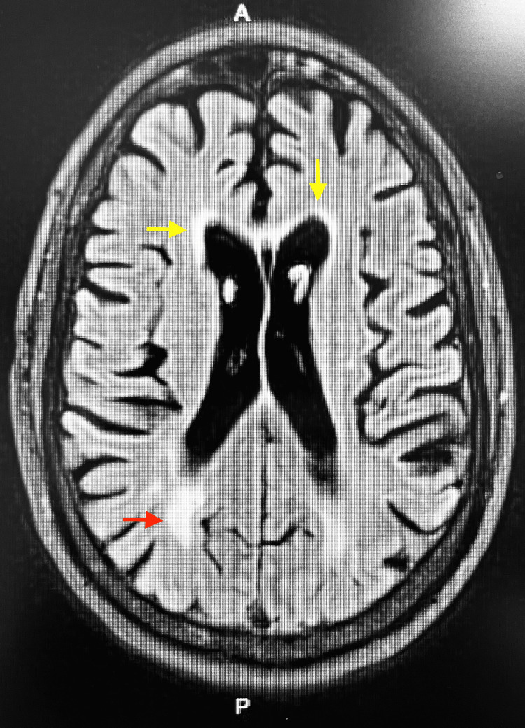 MRI Brain showing increased T2 signal within the periventricular (yellow arrows) and subcortical (red arrow) white matter; characteristic of toxic leukoencephalopathy.