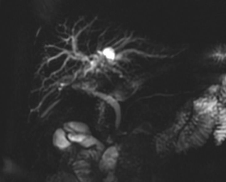 Magnetic resonance cholangiopancreatography did not reveal any significant calculi.