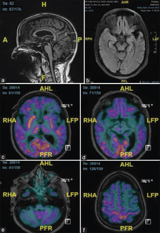 Head T1 MPRAGE sagittal showing the humming bird sign with midbrain atrophy. (b) Head T2 dark fluid transverse showing left side midbrain atrophy. (c) 18F-FDG MR/PET axial fused showing hypometabolism involving the left thalamus, striatum, frontal, and temporal lobes. (d) 18F-FDG MR/PET axial fused showing hypometabolism involving the midbrain left side. (e) 18F-FDG MR/PET axial fused showing hypometabolism involving the right cerebellum. (f) 18F-FDG MR/PET axial fused showing maintained left perirolandic region. 18F-FDG MR/PET: F18-fluorodeoxyglucose magnetic resonance/positron emission tomography