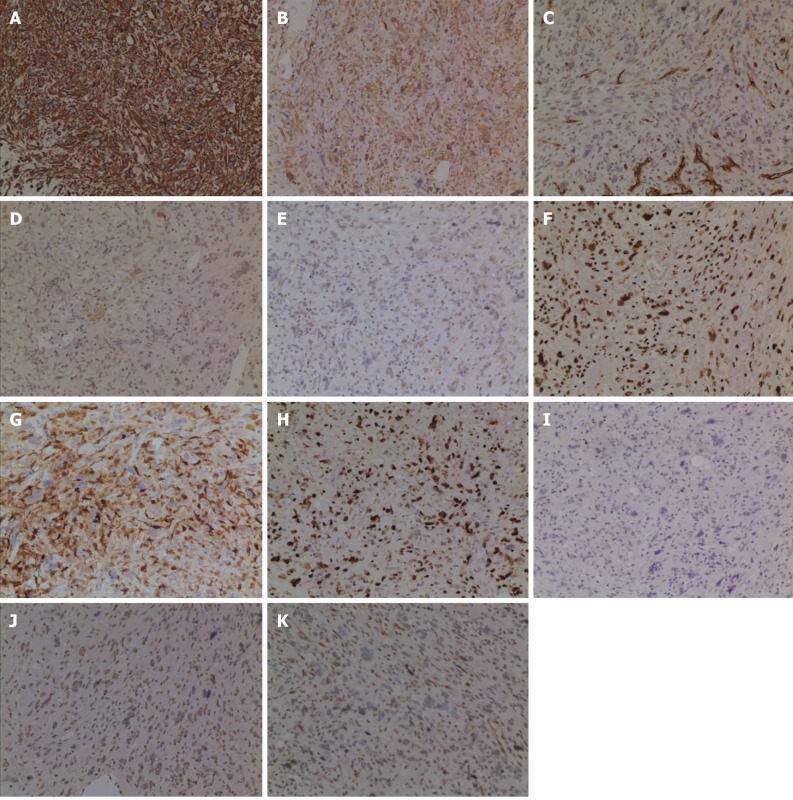 Immunohistochemical examination findings. A: The tissue was diffusively positive for Vimentin; B: The tissue was partially positive for SMA; C: The tissue was partially positive for CD34; D: The tissue was scatteredly positive for CK (AE1/AE3); E: The tissue was scatteredly positive for EMA; F: The tissue was partially positive for H3K27Me3; G: The tissue was partially positive for S-100; H: Ki-67 was approximately 60%; I: The tissue was negative for CK7; J: The tissue was negative for Desmin; K: The tissue was negative for CD117.