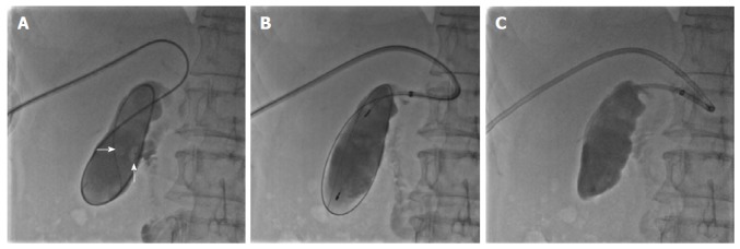 Percutaneous clearance of gallbladder stones. A: Sequential introduction of a guidewire and 4-Fr single-angle catheter into the gallbladder through the cystic duct, and cholangiography showing the number, size, and location of the gallbladder stones (white arrow); B: Capture of stones in a metallic basket; C: Aspiration of sandy stones out of the body through a guide catheter.