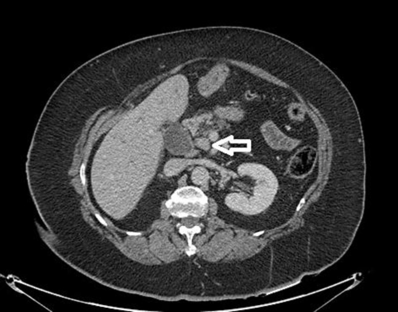 CT of the abdomen and pelvis demonstrated a mass in the CBD with no liver involvement. The arrow points at metastatic breast cancer in the CBD, with dilation of the CBD distal to the mass.