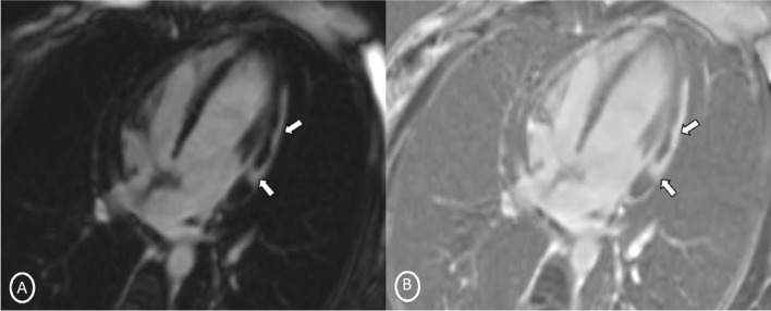 Long-axis 4-chamber PSIR sequence—A MAG; B PHASE images—showing patchy delayed gadolinium enhancement of intramural, subepicardial as all tans-mural enhancement along the left lateral wall