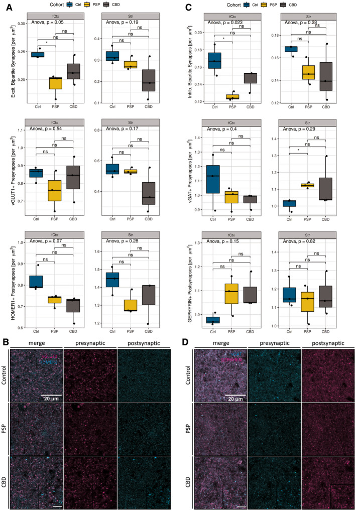 Bipartite synapse quantifications. (a) Statistical analysis of excitatory synapses (# synapses per µm2) facetted by region (left column: fCtx, right column: Str) and markers (vGLUT1, HOMER1). Significant reductions of bipartite excitatory synapses in PSP‐fCtx and trending isolated postsynaptic loss in PSP‐ and CBD‐fCtx. Boxplots show synapse densities for colocalized pre‐ and postsynaptic positive (+) signal (1st row), presynapses only (2nd row), and postsynapses (3rd row) in the fCtx and Str. The color code indicates disease entity. Black dots depict values of single cases. The upper and lower hinges of each box correspond to the 75th and 25th percentiles, while median values are represented by a black bar. Whiskers display the range of data within 1.5 of the inter‐quartile range. Significance statements are depicted according to the analysis of variance (ANOVA) with Tukey post hoc correction (entire groups) or t‐test (pair‐wise group comparisons). Results are expressed as decimal (ANOVA) or indicated as *p < 0.05 and ns = “not significant” (t‐test). (b) Confocal ex vivo images of the merged pre‐ and postsynaptic markers for excitatory synapses (vGLUT1 and HOMER1, left), presynaptic (middle column), and postsynaptic (right) in the fCtx of controls (1st row), PSP (2nd row), and CBD (3rd row) subjects. Scale bars: 20 µm (main), 10 µm (inset). (c) Statistical analysis of inhibitory synapses (# synapses per µm2) facetted by region (left column: fCtx, right: Str) and markers (vGAT, GEPHYRIN). Significant reductions of inhibitory synapse density in the fCtx and significant increases of inhibitory presynapses in the Str of PSP patients. Depiction and statistical assessment according to (a). (d) Confocal ex vivo images of the merged pre‐ and postsynaptic markers for inhibitory synapses (vGAT and GEPHYRIN, left), presynaptic (middle column), and postsynaptic (right) in the fCtx of controls, PSP and CBD subjects. Scale bars according to (c). fCtx, cortex of the MFG; Str, striatum