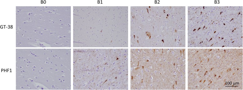 GT-38 validation for Braak staging. GT-38 IHC staining of AD-tau pathology compared to the diagnostic standard antibody PHF1 detects NFTs to a similar extent, but fewer neuropil threads in CA1 regions of hippocampal tissue sections from cases of varying Braak stages (B0-B3) and AD-tau severity