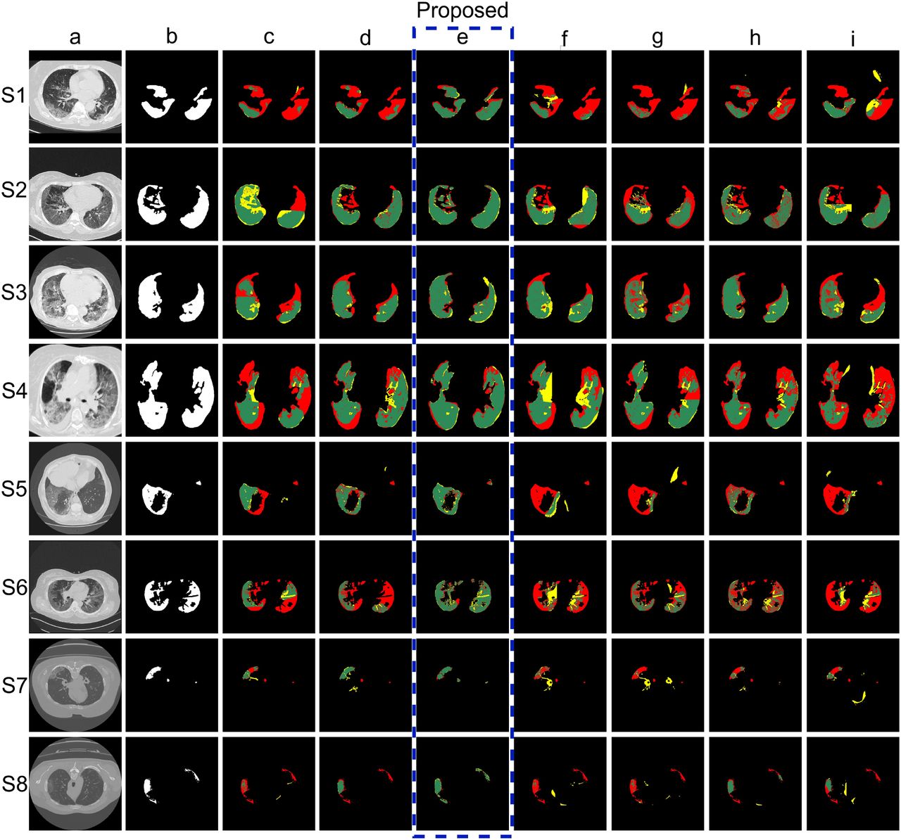 Sample segmentation output by base classifiers, in the uniform framework of ensembling with LOPO. (a) Original CT scan, with (b) Annotated masks. Segmentation obtained by (c) U -Net, (d) Attention U -Net, (e) AMC-Net, (f) R2UNet, (g) Inception Net, (h) Xception Net, and (i) DenseNet, where regions Green: True Positive, Red: False Negative, Yellow: False Positive