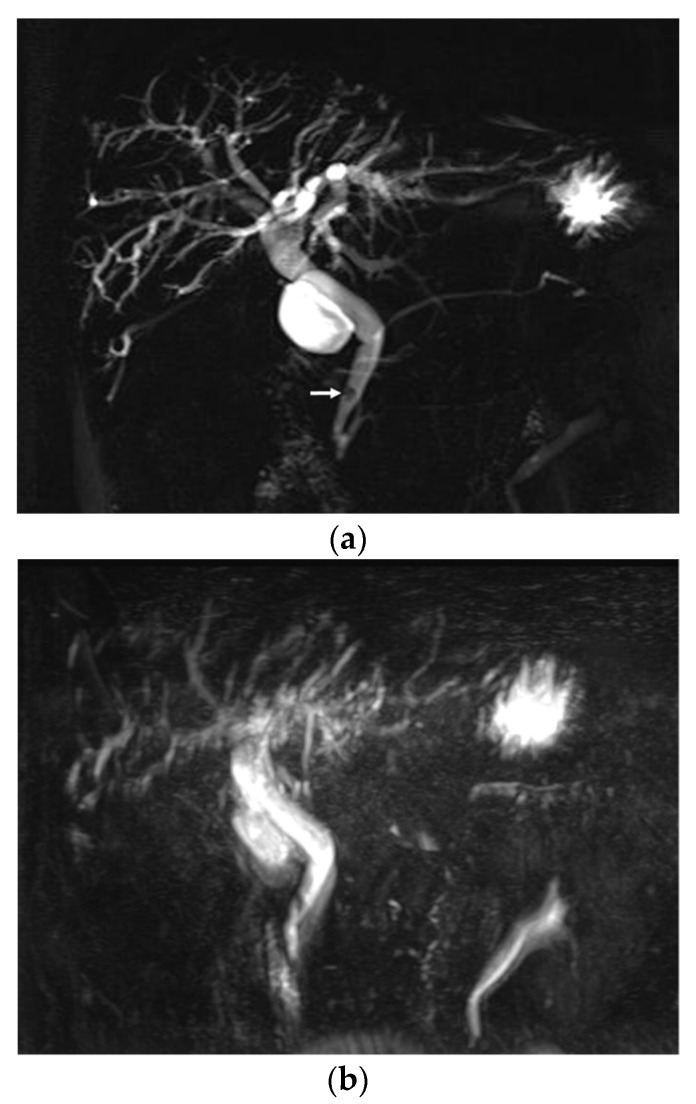 A 61-year-old male with a 5 mm sized distal CBD stone. A 2D thick-slab MRCP (a), as a reference standard, clearly depicts distal CBD stone (arrow) with upstream biliary dilatation. On conventional MRCP (b), the overall image quality is poor (score 1) mainly due to image degradation by severe artifacts (score 2), and the evaluation for the presence of distal CBD stone is limited. On optimized BH-CS-MRCP (c), overall image quality, image degradation by artifacts, and background suppression were excellent (score 5). In addition, visualization of distal CBD stone (arrow) as well as second branch IHD (solid arrowheads) and pancreatic duct (hollow arrowheads) is seen (score 5 for all of the pancreaticobiliary system).