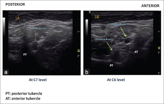 (a) Identification of C7 level: Prominent posterior tubercle with almost no anterior tubercle. (b) Identification of C6 level: Prominent anterior tubercle (Chassaignac tubercle)