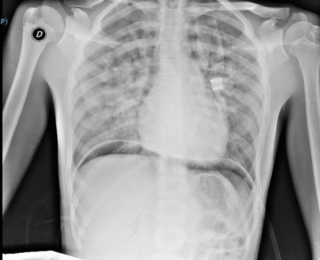 Chest x-ray at clinical onset of symptoms, consistent with diffuse alveolar hemorrhage (DAH). There can be observed infiltrative opacification pattern mainly seen in the mid zones with apical sparing suggestive for impaired pulmonary microcirculation. There can be noticed areas of subdiaphragmatic air due to laparoscopy.