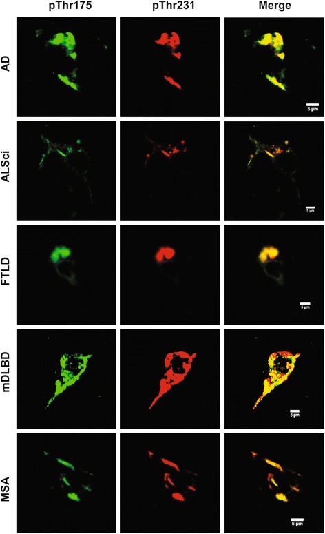 Co-localization of pThr175 and pThr231 tau in hippocampal neuronal inclusions. AD: Alzheimer’s disease. ALSci: amyotrophic lateral sclerosis with cognitive impairment. FTLD: frontotemporal lobar dementia. mDLBD: mixed diffuse dementia with Lewy bodies. MSA: Multiple system atrophy. Scale bar represents 5 μm