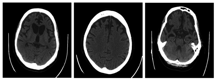 computed tomography (CT) scan: Cortical brain atrophy is more significant in the frontal, parietal, and temporal lobes. Dilatation of both lateral ventricles, especially in the frontal horn and third and fourth ventricles, suggests focal atrophy