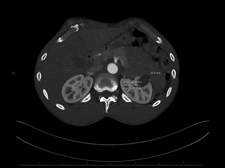 CT angiogram of the aorta and bilateral iliofemoral arterial runoff, which showed an indeterminate low-density lesion in the left kidney measuring 2.5 cm, indicative of a benign left renal cystCT: computed tomography
