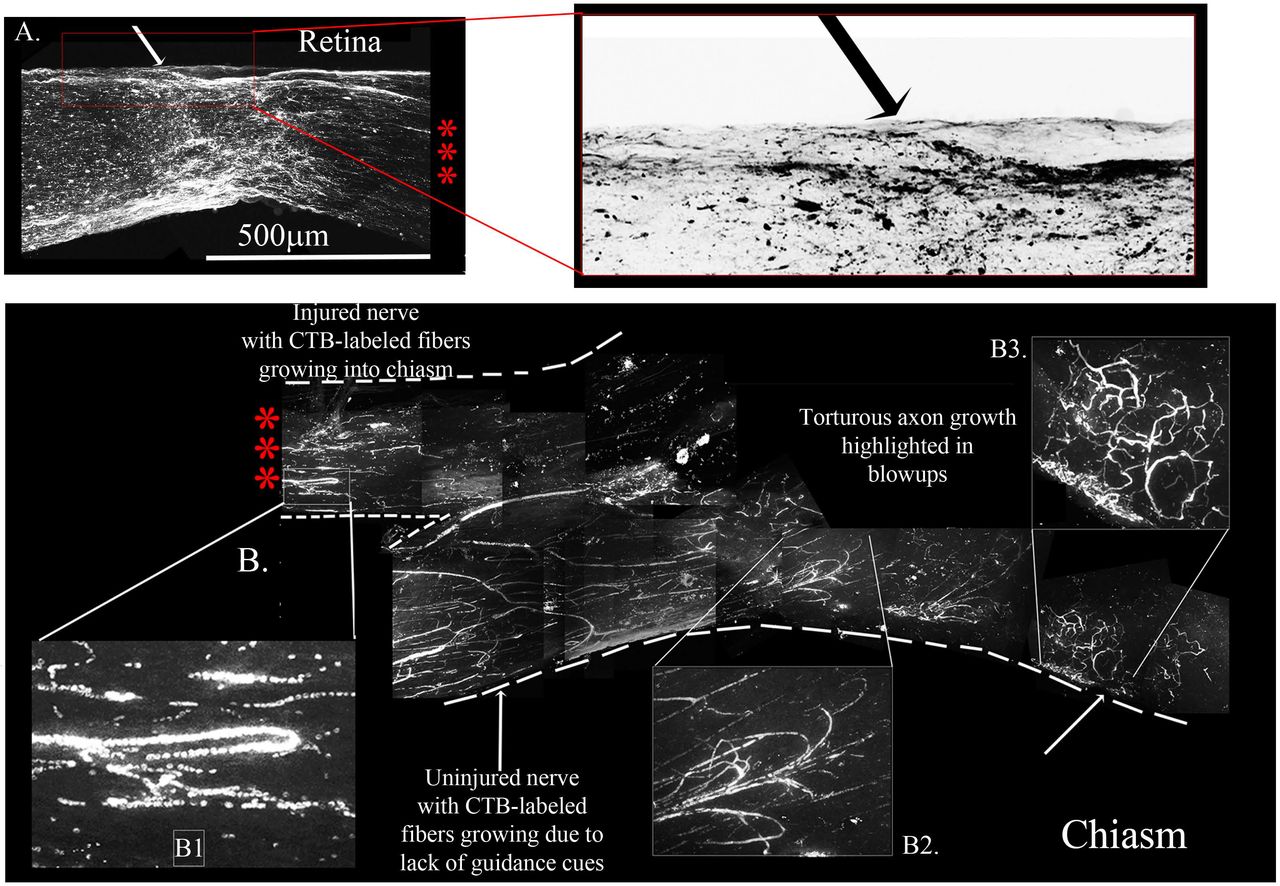 Four-Drug combination in the rat ONC model promotes axonal regeneration to the chiasm.Four-Drug treatment revealing torturous pattern of growth from the Retina (A) chiasm (B) from the same animal, this animal we waited 7days post CTB-labeling. The three red asterisks between the Retina with the crush site (A) to the chiasm (B) represent the same nerve without 6mm of the nerve between, from 0.5mm from the crush site to the chiasm. The red box is enlarged of the crush site in A is inverted to reveal the crushed regenerating axons C. Brain sections that are immunostained for CTB revealed CTB labeled neurons and fibers in the superior colliculus. CTB (green) and PSD95 (red) colocalize (yellow) in neurons in the superior colliculus, as highlighted by the white arrows. D. Graph of control, 1-3, and Four-Drug treatments showing long axons only grew in the presence of all four drugs.