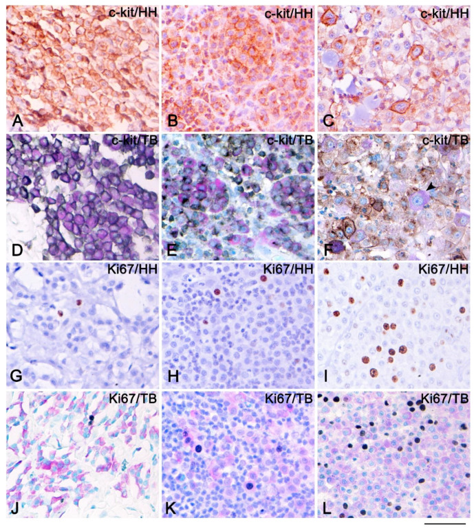 Immunohistochemistry of c-kit and Ki67 counterstained either with Harris hematoxylin (HH) or toluidine blue (TB) stain of cutaneous mast cell tumors (MCTs). Immunohistochemistry of c-kit of MCTs Patnaik grade 1 and Kiupel low grade counterstained either with HH (A) or TB (D) showed membranous expression of c-kit; therefore, the metachromatic reaction of the TB stain is visible. Immunohistochemistry of c-kit of MCTs Patnaik grade 2 and Kiupel low grade counterstained either with HH (B) or TB (E) showed a membranous and Golgi-like pattern of c-kit; therefore, the metachromatic reaction of TB is detectable. Immunohistochemistry of c-kit of MCTs Patnaik grade 3 and Kiupel high grade counterstained either with HH (C) or TB (F) showed a cytoplasmic pattern of c-kit, and some MCs were negative for c-kit (black arrow); therefore, the metachromatic reaction is visible only in c-kit negative MCs. Immunohistochemistry of Ki67 of MCT Patnaik grade 1 (G,J), grade 2 (H,K), and grade 3 (I,L) counterstained either with HH (G–I) or TB (J–L). Scale bar = 50 µm.
