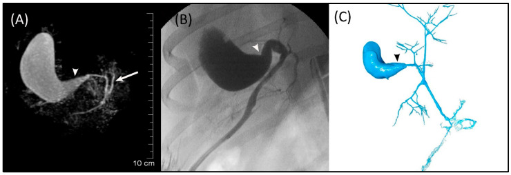 Images of Dog 8 with acute extrahepatic cholestasis and focal destructive cholangitis. (A) 3D-TSE-MRCP illustrating dilated gallbladder neck (arrowhead). Normal left extrahepatic duct is visible (arrow). (B) FRCP image showing dilated gallbladder neck (arrowhead). (C) Corrosion cast demonstrating dilated gallbladder neck (arrowhead).