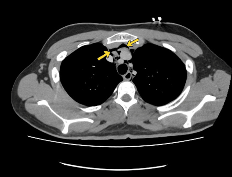 CT Chest with oral contrast showing pneumomediastinum