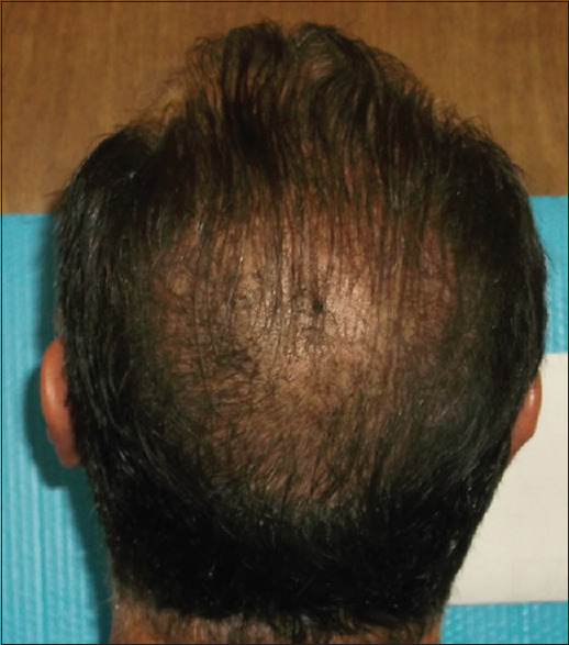 Male– Day 180-19 hairs/cm2