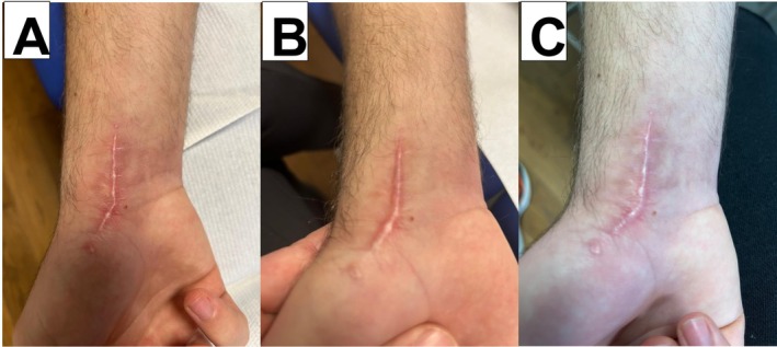Clinical appearance of a keloid scar following scaphoid osteosynthesis. Three sessions of Transferred Energy Capacitive and Resistive (TECAR) therapy were administered: one at baseline (A), one on Day 7 (B), and one on Day 21 (C). The conductive cream was mixed with 30% tested cream gel. Additionally, the patient self‐administered the cream gel alone twice daily from baseline to Day 21. On Day 21, the scar was treatable with skin rolling. TECAR therapy uses high‐frequency currents, applied via electrodes, to stimulate ions and tissues either superficially or deeply. This treatment generates endogenous heat, which reduces pain and inflammation. It also improves tissue repair by increasing microcirculation, cellular metabolism, and lymphatic drainage.