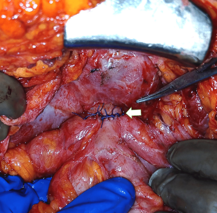 Stricturoplasty accomplished by transverse closure (white arrow) of the longitudinal incision across the anastomotic stricture at the common hepatic duct.