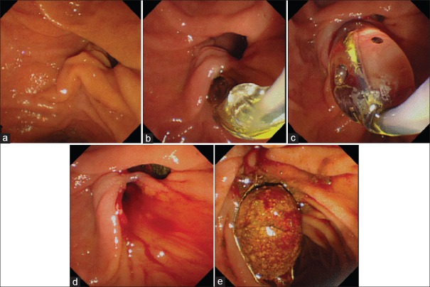 A huge stone is impacted at the bile duct bifurcation. Removal with a large basket catheter and mechanical lithotripter fails, and retrieval of a large stone is attempted with a retrieval balloon catheter. (a-d) After sphincterotomy, large balloon dilation is performed up to 18 mm. (e) The stone is pulled out with a large basket and extracted from the papilla. A huge stone (4.5 × 2.0 cm) is finally evacuated without crushing
